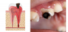 Bệnh Sâu răng (dental caries)